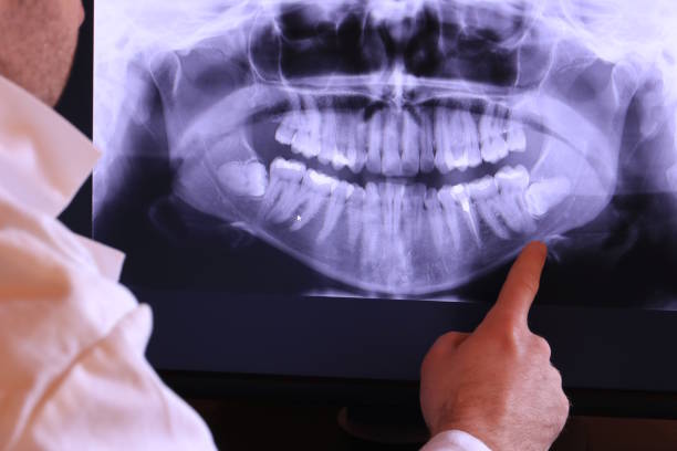 Best Knocked-Out Tooth (Avulsed Tooth) Treatment in Brookville, PA